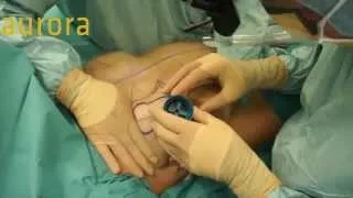 Mammoplasty Surgery (Breast Reduction)