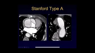 CT evaluation of Aortic dissection and intramural hematoma