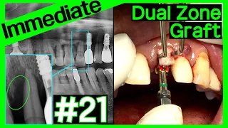 [Online Surgery] Maxillary anterior immediate implant placement&dual zone graft with OneGuide system