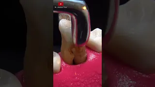 Tooth extraction procedure in 4k