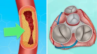 Coronary Artery Disease & Heart Valve Surgery: What Should Patients Know?