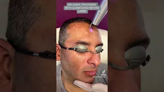 Melasma treatment