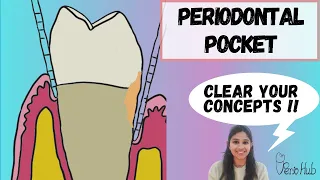 PERIODONTAL POCKET ‖ Classification of Pocket ‖ Pathogenesis of Periodontal Pocket ‖ Perio Hub