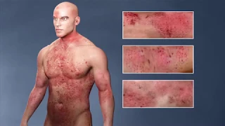 Atopic Dermatitis, (eczema); From the Inside Out