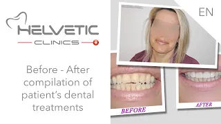 Before - After compilation - Helvetic Clinics, Dental Clinic Abroad.