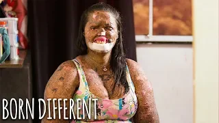 My Skin Condition Hasn't Stopped Me Finding Love | BORN DIFFERENT