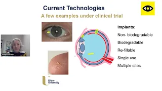 Using eye drops to treat wet AMD with Prof. Bridgeen Callan