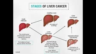 Liver Tumour-Benign and Malignant Liver tumour-Primary & secondary liver tumour