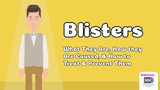 Blisters - What They Are, How they Are Caused, & How to Treat & Prevent Them