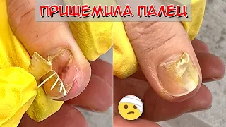 Прищемила палец дверью / Сошел ноготь на руке, что делать?