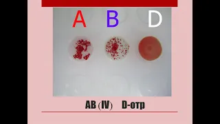 Определение группы крови цоликлонами-1.