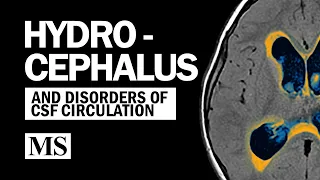 Hydrocephalus And the Disorders of CSF Circulation