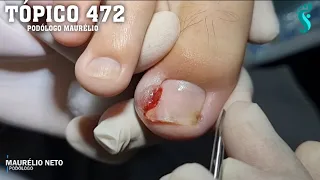 A VERDADEIRA UNHA ENCRAVADA (THE TRUE INGROWN TOENAIL) - PODÓLOGO MAURÉLIO