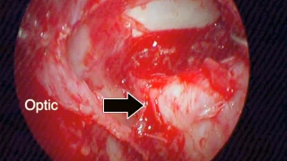 Schwannoma around optic nerve