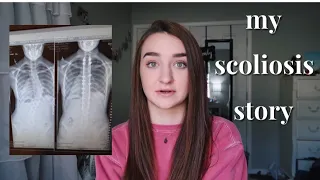 MY SCOLIOSIS STORY: back brace, spinal fusion surgery, & recovery