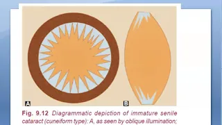 Ophthalmology 193 Cortical Senile Cataract Incipient Immature Mature HyperMature Morgagnian Soft