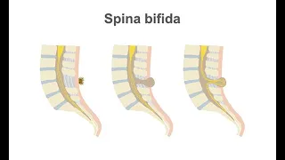 Managing spina bifida