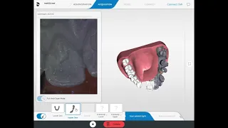 Digital implant impression - CEREC Omnicam, SW 5.1