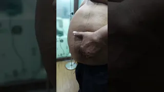 360 Abdominal Liposuction | Liposuction #short #shortvideo #shorts