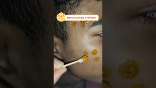 😌Remove pimple in overnight permanently/Overnight Acne Treatment #ytshorts #viralvedios #acneremoval