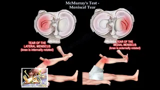 McMurray's Test,Meniscal Tear - Everything You Need To Know - Dr. Nabil Ebraheim