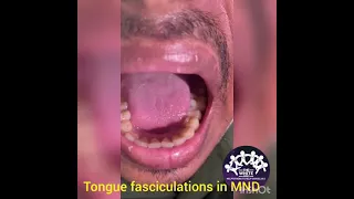 TONGUE FASCICULATIONS