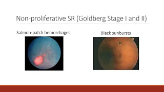 Sickle Cell Retinopathy