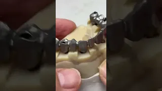 Full mouth implants!