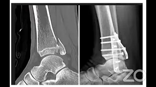 Modernization of Ankle Fracture Management
