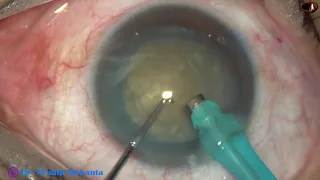 Managing a Hard white mature cataract (Unedited recording) : Pradip Mohanta, 9 Dec, 2019