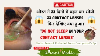 Doctor removes 23 contact lenses from woman's eye |23 Contact lenses in eye viral video| Unani Medic