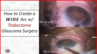 How to Create a Wide Arc with Trabectome Micro Invasive Glaucoma Surgery