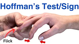 How to Perform a Hoffman's Test - Inverted Supinator Sign - Clonus - Hyperreflexia