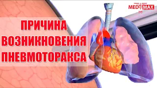 Что такое пневмоторакс?