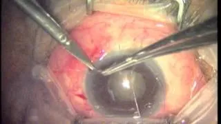 Glaucoma: Trabeculectomy