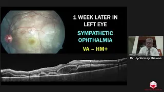 "Panuveitis - Clinical Features, Differential Diagnosis and Approach To Management"