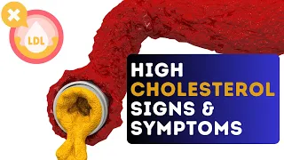 High Cholesterol: Identifying the 9 Signs and Symptoms
