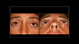 Orbital Cavernous hemangioma. Orbitotomy. Orbital pathology. Tumores orbitarios. Clínica Moreiras