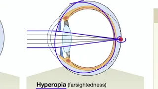 Light Refraction and Focused Vision in the Eye