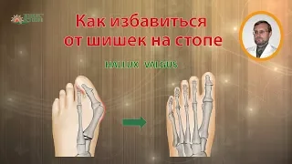 Как избавиться от косточки или шишки на большом пальце стопы / Hallux Valgus