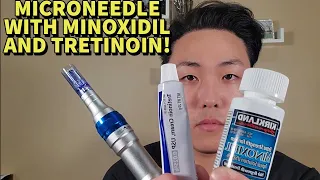 HOW TO MICRONEEDLE WITH MINOXIDIL AND TRETINOIN FOR MAXIMUM HAIR GROWTH (STEP BY STEP GUIDE)