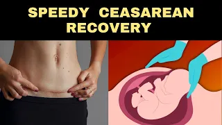 Speed Up Your C-Section (Caesarean) Recovery with These Health Tips!