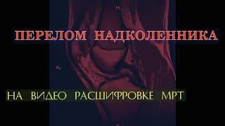 ПЕРЕЛОМ НАДКОЛЕННИКА с формированием ЛОЖНОГО СУСТАВА на ВИДЕО РАСШИФРОВКЕ МРТ коленного сустава