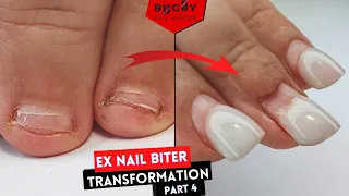 Ex Nail Biter Transformation Finale | Couldn't Believe My Eyes! | 2 Corrections In 1