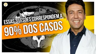 Quais são os SUBTIPOS DE CARCINOMAS de Células Renais mais comuns?