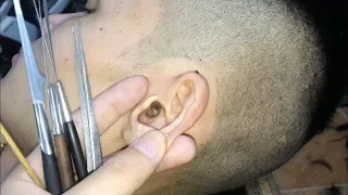 Clean the earwax dry and get rid of the ears