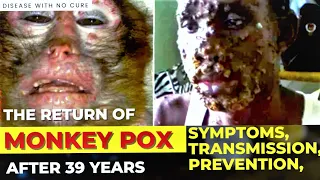 Monkeypox : rare virus infection | From monkey pox virus Symptoms to Spread, All You Need to Know