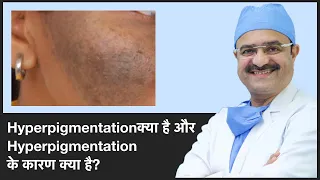 What Is Hyperpigmentation And Causes Of Hyperpigmentation: Part 1 | ClearSkin, Pune | (In HINDI)
