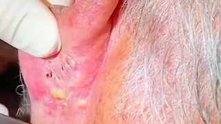 blackheads Remove blackheads and acne from the ear