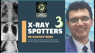 XRAY SPOTTERS 3 || DR SANJEEV MANI || ICU Lines | Lung tumors | Lung mets